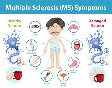 multiple sklerose icd